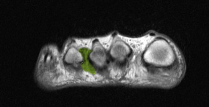 MRT (Magnetresonanztomographie) eines Fußes mit Morton Neurom von vorne (grün). Das Morton Neurom sitzt zwischen den Zehen 3/4. Es handelt sich nicht um eine gutartige Wucherung des Nervengewebes, sondern eher eine Entzündung der bindegewebigen Nervenhülle. © Gelenk-Klinik MRT (Magnetresonanztomografie): Aufnahme eines Morton Neuroms