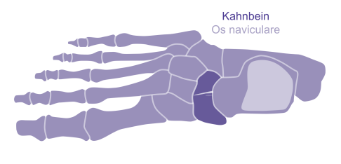 Stressfraktur des Kahnbeins. Sie entsteht immer längs der Fußachse und verläuft quer durch den Knochen. © Gelenk-Klinik Stressfraktur Kahnbein