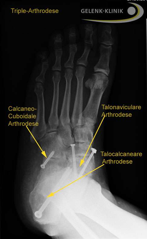 Röntgenbild der Triple-Arthrodese von oben gesehen. © Gelenk-Klinik Triple-Arthrodese von oben