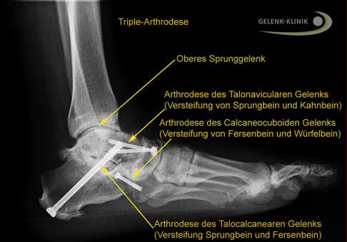 Röntgenbild: Die Triple-Arthrodese kann das untere Sprunggelenk (USG) bei Arthrose der drei Gelenke oder bei schweren Fehlstellungen, v. a. des Fersenbeins (Calcaneus), therapeutisch versteifen. © Gelenk-Klinik Röntgenbild der Triple-Arthrodese
