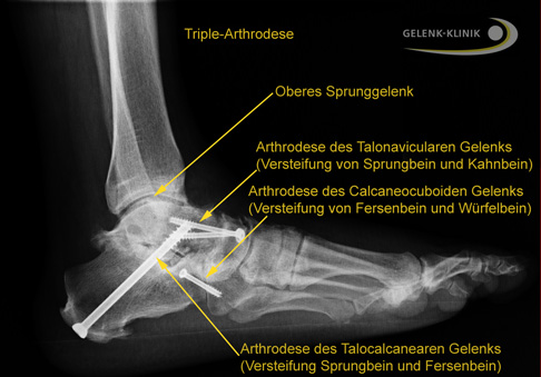 Die Triple-Arthrodese ist ein operatives Verfahren, das bei stark fortgeschrittener Charcot-Marie-Tooth-Erkrankung das Fußgewölbe stabilisiert. © Gelenk-Klinik Röntgen: Triple-Arthrodese
