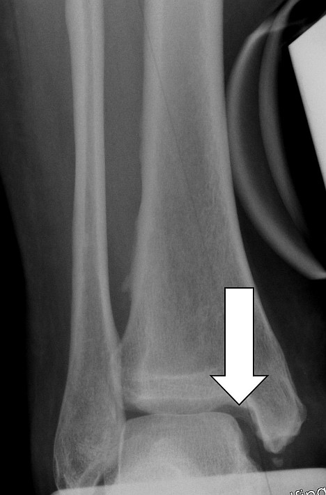 Die Fehlstellung der Sprunggelenksgabel führt zu einem vergrößerten Abstand zwischen Talus (Sprungbein) und Tibia (Schienbein). Die Pfeile zeigen die fehlende Übereinstimmung zwischen den Gelenkpartnern. Diese Fehlstellung der Sprunggelenksgabel kann unbehandelt zu Arthrose im Sprunggelenk führen. © Dr. Thomas Schneider Die Fehlstellung der Sprunggelenksgabel vergrößert den Abstand zwischen Talus (Sprungbein) und Tibia (Schienbein).
