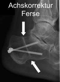 Röntgenbild nach Umstellungsoperation des Fersenbeins. Die Umstellungsoperation (Osteotomie) des fehlgestellten Fersenbeins kann die Belastungslinie der Beinachse im Sprunggelenk wieder normalisieren. © Gelenk-Klinik Achskorrektur durch Osteotomie