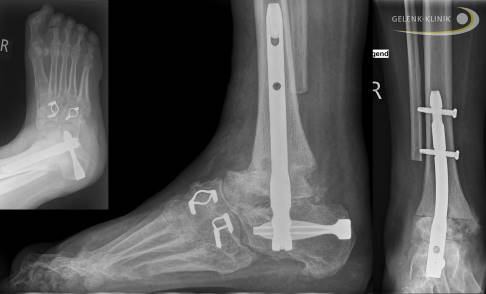 Das Endstadium einer Charcot-Marie-Tooth-Erkrankung und jeder schweren Fehlstellung lässt sich nur durch eine Begradigung und Versteifung behandeln. Die weitere Stellungskorrektur bringt dem Patienten Mobilität ohne orthopädischen Schuh. Ein gerader Auftritt des Fußes kann in diesem Endstadium vor allem bei sehr jungen Patienten die Lebensqualität stark verbessern. Eine Prothesenversorgung bei gleichzeitiger Lähmung ist oft nicht möglich. © Gelenk-Klinik Versteifung bei einer starken Fußfehlstellung im Rahmen einer CMT-Erkrankung