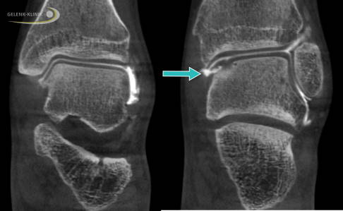 Arthrografie im oberen Sprunggelenk: Im DVT unter Belastung ist links ein gesundes Gelenk dargestellt. Von oben kommt das Schienbein, in der Mitte liegt das Sprungbein. Die dunkle Schicht, die die beiden Gelenkpartner überzieht, ist der Knorpel. Die weiße Schicht dazwischen ist das Kontrastmittel. Rechts erkennt man in weiten Teilen einen ähnlichen Aufbau bei intakter Knorpelschicht. Der Pfeil zeigt den Eintritt des Kontrastmittels unter den Knorpel. Dies ist ein direkter Nachweis des Knorpelschadens innen am Sprungbein. © Gelenk-Klinik Knorpelriss im Sprunggelenk