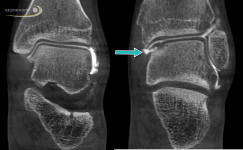 Knorpelriss im Sprunggelenk