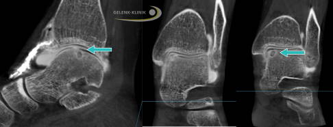 Digitale Volumentomografie (DVT) des Sprunggelenks: Der schwarze Überzug zwischen den Knochen ist der Gelenkknorpel. Er ist am Knorpelschaden unterbrochen (Pfeil). Das sichtbare Loch im Knochen ist eine Zyste, die durch Knochenumbau oder durch Knochennekrose (Knochentod) entstehen kann. © Gelenk-Klinik Knorpelschaden im Sprunggelenk