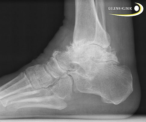 Arthrose im Sprunggelenk: Die Knochenflächen reiben schmerzhaft aufeinander, sodass ein normales Abrollen unmöglich wird. © Gelenk-Klinik Arthrose im Sprunggelenk