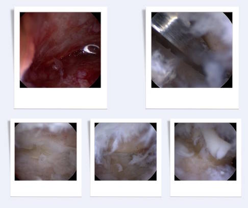 Bilder einer arthroskopisch perkutanen Versteifung des Subtalargelenkes. Unter Sicht ist eine Bearbeitung des Knorpels, des Knochens und der Weichteile minimalinvasiv möglich. Ebenso lassen sich zusätzliche Stellungskorrekturen und Begradigungen durchführen. © Gelenk-Klinik Arthroskopische Arthrodese des Subtalargelenks