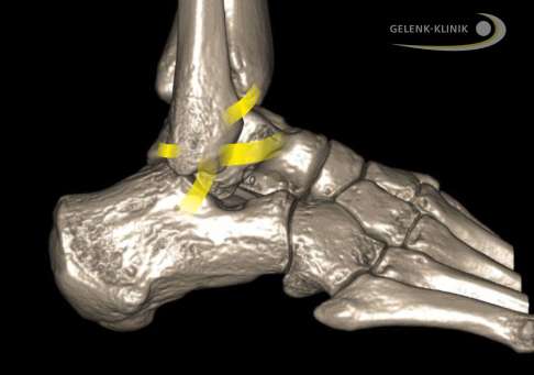 DVT-Aufnahme (digitale Volumentomografie) des Sprunggelenks: Gelb eingezeichnet sind die Außenbänder und – zwischen Schienbein und Wadenbein – das Syndesmoseband. © Dr. Thomas Schneider DVT-Aufnahme des Sprunggelenks