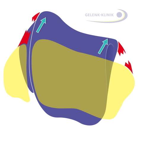 Sprunggelenk von oben: Gelb eingezeichnet ist die Sprunggelenksgabel aus Wadenbein (links) und Schienbein (rechts). Bänderrisse (rot) können zu einer Fehlstellung des Sprungbeins (violett) im Sprunggelenk führen. © Dr. Thomas Schneider Fehlstellung
