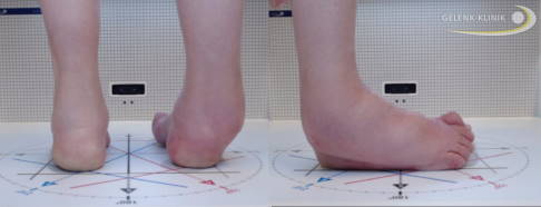 Klinisches Bild vor der OP: Die Fußform hat sich im Rahmen der Charcot-Marie-Tooth-Erkrankung deutlich verändert. © Gelenk-Klinik klinisches Bild einer Fußdeformierung durch Charcot-Marie-Tooth