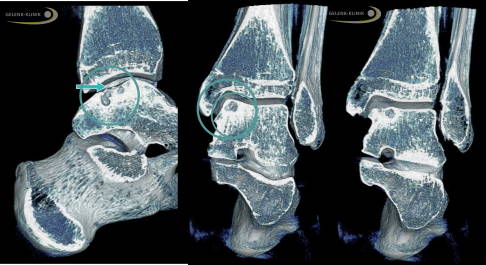 Digitale Volumentomographie (DVT): Der Defekt unter dem Knorpelschaden sieht von der Oberfläche betrachtet wie eine kleine Einsenkung aus (Pfeil). Die Knochensubstanz ist an dieser Stelle durch den Knorpelschaden angegriffen. Die Beurteilung des Untergrundes ist ein wichtiger Teil der Behandlungsentscheidung. © Gelenk-Klinik Die digitale Volumentomografie zeigt eine osteochondrale Läsion am Sprunggelenk.