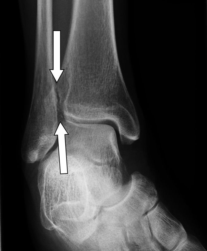 Eine Fehlstellung der Sprunggelenksgabel führt zu Überbeweglichkeit im Sprunggelenk. Die Pfeile zeigen die fehlende Übereinstimmung zwischen Schienbein (Tibia) und Wadenbein (Fibula) nach einem Riss des Syndesmosebandes. © Dr. Thomas Schneider Eine Fehlstellung der Sprunggelenksgabel führt zu Überbeweglichkeit im Sprunggelenk.