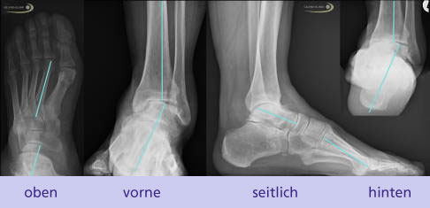 Röntgenbilder eines Patienten mit einem medialen Ballenhohlfuß mit Fehlstellung des Rückfußes (oben rechts). Sichtbar ist eine Varusverkippung des Fersenbeins mit Auswirkung auf die Stellung des Sprunggelenkes in der Sprunggelenksgabel zwischen Schien- und Wadenbein (2. Bild von links). Hier verkippt der Sprungbeinknochen (Talus) nach außen. Die Fehlstellung der Ferse bewirkt eine Arthroseentstehung auf der Innenseite im oberen Sprunggelenk. Es ist kein Gelenkspalt mehr sichtbar. © Gelenk-Klinik medialer Ballenhohlfuß und Fehlstellung des Rückfußes im Röntgen