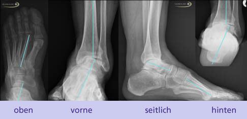 medialer Ballenhohlfuß und Fehlstellung des Rückfußes im Röntgen