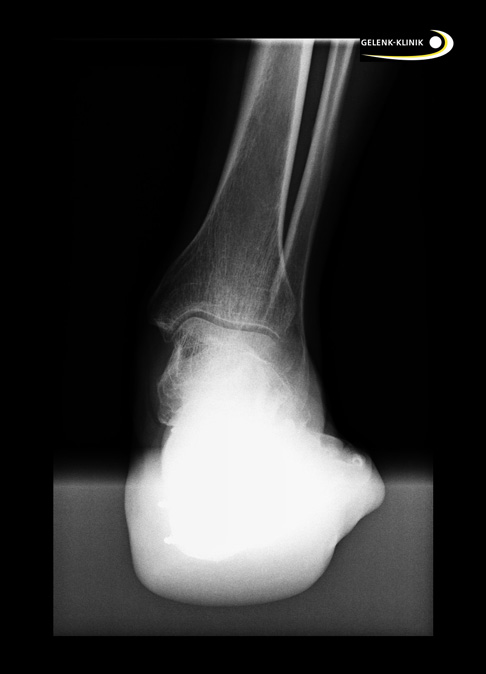 Röntgenaufnahme einer Fehlstellung des Rückfußes nach Fersenbeinfraktur. Wegen der Gefahr einer Arthrose des unteren Sprunggelenks, spricht man hier auch von einer prä-arthrotischen Fehlstellung. © Gelenk-Klinik.de Röntgenaufnahme einer Fehlstellung des Rückfußes nach Fersenbeinfraktur.