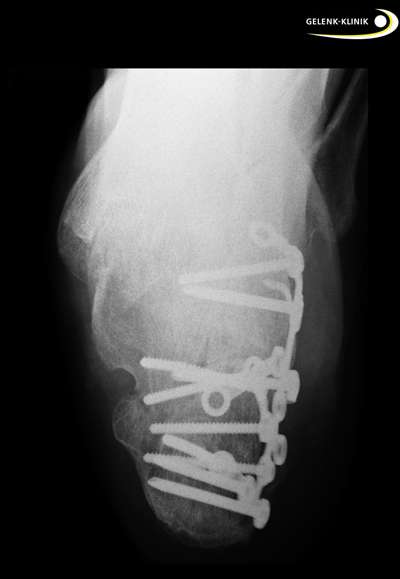 Röntgenaufnahme einer komplexen Fersenbeinfraktur nach operativer Erstversorgung. Die operative Stabilisierung mit Schrauben und Platten soll die Knochenfragmente wieder repositionieren und die subtalare Gelenkfläche zwischen Fersenbein und Sprungbein wiederherstellen. © Gelenk-Klinik Röntgenaufnahme einer komplexen Fersenbeinfraktur nach der operativen Erstversorgung