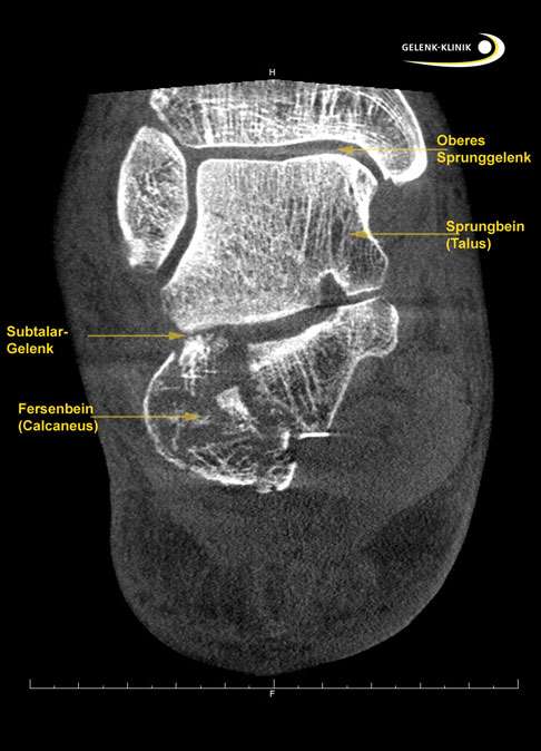 SPECT-CT-Aufnahme einer komplexen Fraktur des Fersenbeines. Durch die Fraktur wurde die Gelenkfläche des Subtalargelenkes zerstört. Diese Verletzung, die die Gelenkfläche dauerhaft verändern kann, führt in vielen Fällen zu einer Arthrose des talokalkanearen Gelenks © Gelenk-Klinik.de SPECT-CT-Aufnahme einer komplexen Fraktur des Fersenbeines
