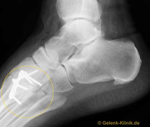 Das seitliche Röntgenbild zeigt den Zustand nach der Versteifung der Fußwurzelgelenke (gelbes Oval). Je nach genauer Lage und der an der Arthrose beteiligten Gelenke werden auch Platten als Implantate eingesetzt, um die Knochen stabil zu verbinden. © Gelenk-Klinik Versteifung (Arthrodese) der Fußgelenke (Fußwurzelgelenke) nach Arthrose mit einer Platte und Schrauben