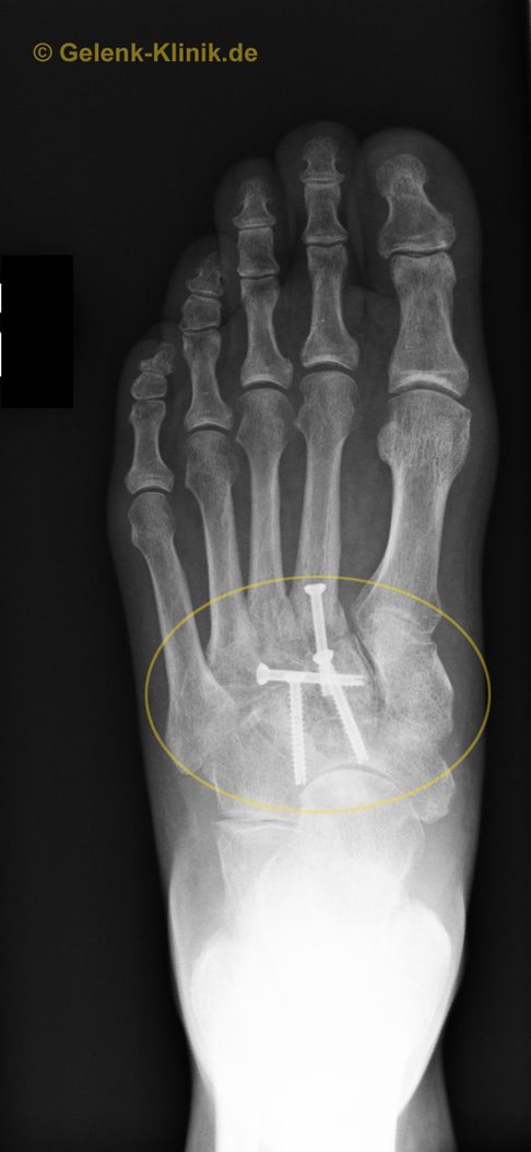 Das Röntgenbild zeigt den Zustand nach der Versteifung der Fußwurzelgelenke (gelbes Oval). Die Implantate heben die Beweglichkeit der Fußwurzelgelenke auf und ermöglichen ein stabiles Verwachsen (Arthrodese) dieser Gelenke. Die Versteifung stoppt die schmerzhaften entzündlichen Prozesse an den Gelenkflächen endgültig. Weil die Beweglichkeit der Fußwurzelknochen nicht im Vordergrund steht, ist diese Versteifung im Alltag ohne Funktionsverlust durchführbar. © Gelenk-Klinik Versteifung (Arthrodese) der Fußgelenke (Fußwurzelgelenke) nach Arthrose