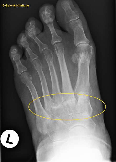 Lisfranc-Gelenk (tarsometatarsales Gelenk, gelbes Oval) einer 70-jährigen Patientin mit Arthrose im Röntgenbild. © Gelenk-Klinik Darstellung des Lisfranc-Gelenks (tarsometatarsales Gelenk) mit Arthrose im Röntgenbild.