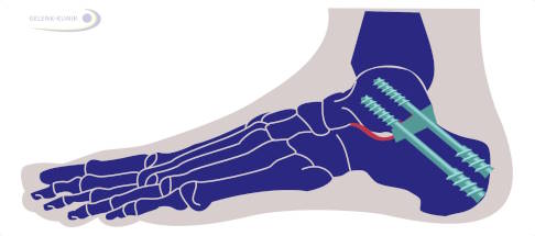 Subtalare Arthrodese mit Stellungskorrektur des Fersenbeins gegenüber dem Sprungbein. Zum Aufrichten des Fersenbeins wurde ein Knochenspan (grün) eingefügt. Zwei Schrauben sichern Span und Arthrodese. © Gelenk-Klinik Grafik Fußskelett mit subtalarer Arthrodese