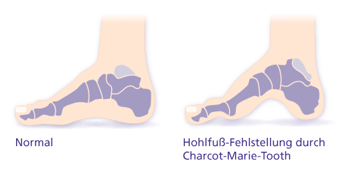 Eine häufig auftretende Fußfehlstellung bei Patienten mit Charcot-Marie-Tooth ist der Hohlfuß. © Gelenk-Klinik Hohlfuß-Fehlstellung durch Charcot-Marie-Tooth