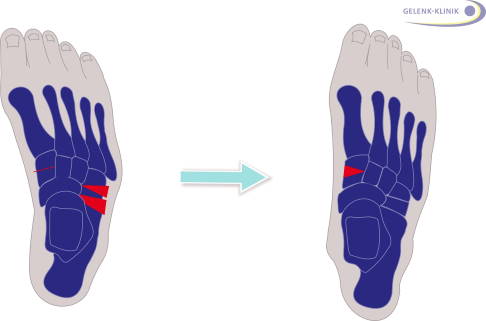 Auch eine Korrektur der Fehlstellung von oben kann in verschieden Arten erfolgen: 1. Additive, also einfügende Operation durch Einpassen eines Knochenspanes in die Osteotomie (Knochendurchtrennung). 2. Subtraktive, also entfernende Umstellung durch Entnahme eines Knochenkeiles. Teilweise werden die Methoden auch kombiniert, sodass man den auf der Außenseite entnommenen Span auf der Innenseite einsetzt. © Gelenk-Klinik additive und subtraktive Korrektur eines Hohlfußes