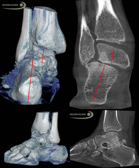 Die Instabilität des Fersenbeins gegenüber dem Sprungbein ist eine typische Indikation für die subtalare Arthrodese. In dieser Aufnahme (links: digitale Volumentomographie mit 3-D Darstellung (DVT), rechts die Schichtauswertung der DVT) ist eine deutliche Verschiebung des Fersenbeines nach außen mit Kontakt zwischen Fersenbein und Wadenbein zu sehen. Außerdem erkennt man eine fortgeschrittene Arthrose und Fehlstellung des übrigen Fußbereiches. Solche Veränderungen führen zu einer massiven Instabilität. © Gelenk-Klinik DVT und Schichtauswertung bei massiver Arthrose und instabilem Fersenbein