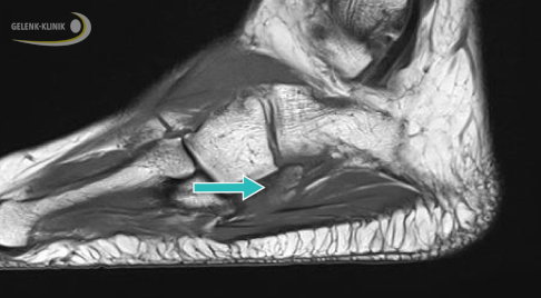 MRT von der Seite. Im Bereich des Os cuboideum liegt ein gereiztes Os peroneum mit Knochenödem. © Gelenk-Klinik Os peroneum mit Knochenödem