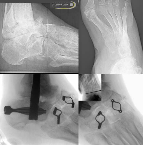 Korrektur der Mittelfußknochen bei einer Patientin mit CMT-Erkrankung
