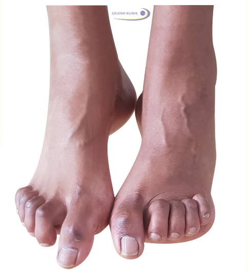 Untersuchung am hängenden Bein: Durch die permanente Beanspruchung der Muskeln entstehen diese Zehenfehlstellungen. © Gelenk-Klinik Zehenfehlstellungen bei Charcot-Marie-Tooth