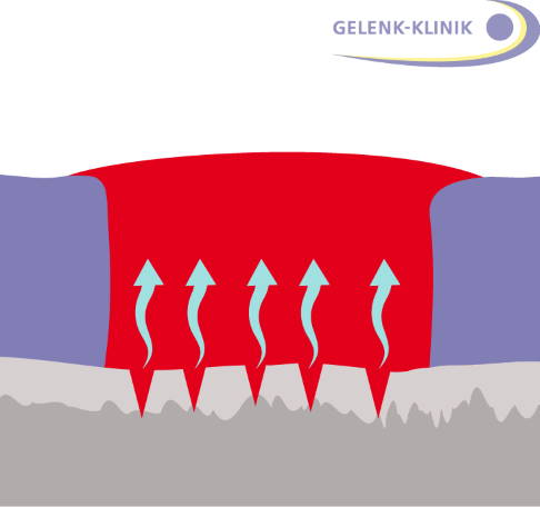 2. Einströmen der Blutstammzellen in die Knorpelschicht. © Gelenk-Klinik Schritt 2 der Pridie-Bohrung