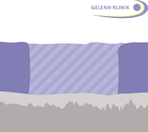 3. Bildung einer neuen Knorpelschicht aus Faserknorpel. © Gelenk-Klinik Schritt 3 der Pridie-Bohrung
