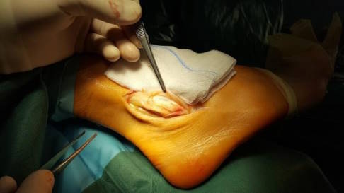 Operation bei Peroneus-Split-Syndrom. Der Längsriss wird ausgeschnitten und die Sehne wieder zusammengenäht. © Gelenk-Klinik Operation beim Peroneus-Split-Syndrom