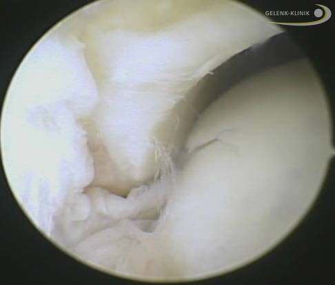 Arthroskopie (Gelenkspiegelung): Die Knorpeloberfläche zeigt einen deutlichen Riss. © Gelenk-Klinik Arthroskopische Sicht auf einen Knorpelriss