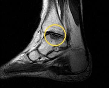 MRT einer Osteochondrosis dissecans am Sprungbein. Markiert ist ein halbkreisförmiger nekrotischer Bereich im Sprungbein mit Wassereinlagerung (Ödem). Osteochondrosis dissecans zerstört die glatte Oberfläche des Knochens. © Gelenk-Klinik MRT-Aufnahme einer Osteochondrosis dissecans am Sprungbein
