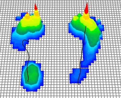 Podometrie-Abdruck