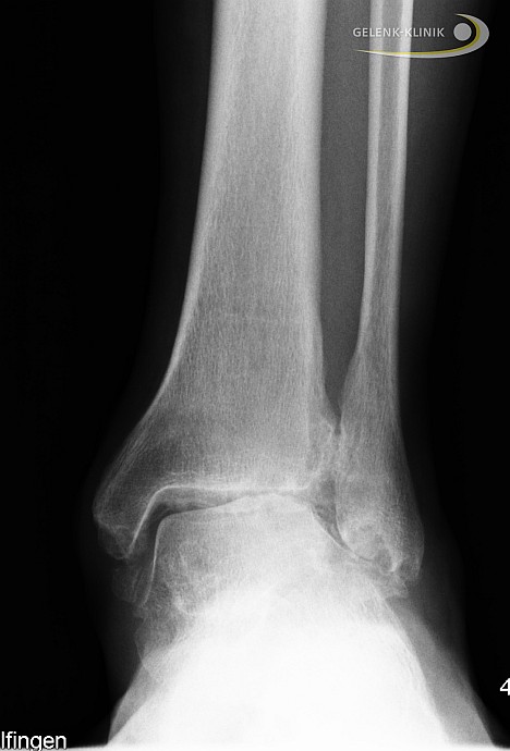 Die Gelenkflächen im Sprunggelenk passen nicht mehr optimal aufeinander. Das unten liegende Sprungbein wird durch die Schrägstellung nur am Außenknöchel belastet. Dort kann sich durch Überlastung Arthrose entwickeln. © Gelenk-Klinik Röntgenbild einer lateralen Sprunggelenksarthrose