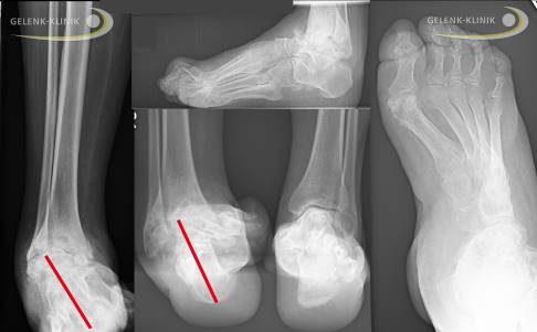 Nach vielen Jahren ohne eine Stellungskorrektur kommt es häufig zur Arthrose und zur Fehlstellung. Diese kann nicht mehr gelenkerhaltend behandelt werden. Eine derartig schwere Fehlstellung im Rahmen der Charcot-Marie-Tooth-Erkrankung schränkt die Lebensqualität sehr stark ein. Solche Fehlstellungen bedürfen vor einer Operation einer guten Planung, einer Gefäßabklärung und einer neurologischen Stellungnahme. © Gelenk-Klinik schwere Fußfehlstellung im Röntgenbild