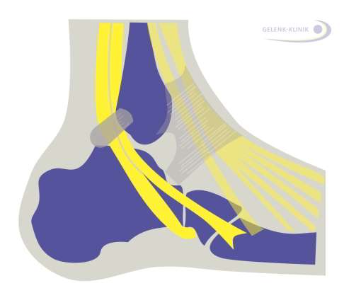 Die für die Funktion des Fußes wichtige Peronealsehne und die Tibialis-posterior-Sehne verlaufen aus dem Unterschenkel um den Außenknöchel herum. Entzündungen dieser Sehnen und Sehnenansätze sind daher häufig als oberflächliche Schmerzen am Sprunggelenk zu spüren. © Dr. Thomas Schneider Peronealsehne und Tibialis-posterior-Sehne