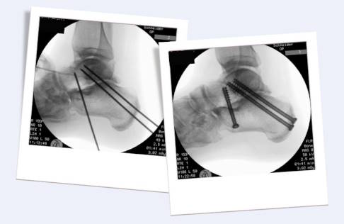Subtalare Arthrodese in der Durchleuchtung: Links nach Einführen der Führungsdrähte, rechts die finale Fixierung mit Schrauben. © Gelenk-Klinik subtalare Arthrodese