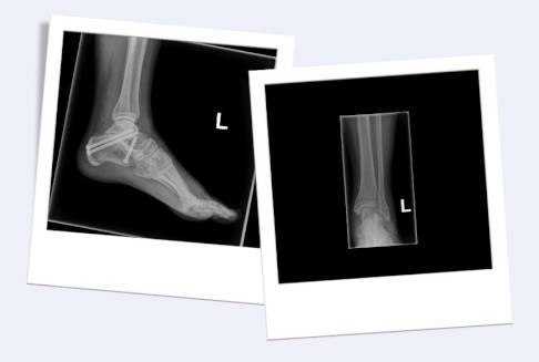 Röntgenbild einer subtalaren Arthrodese von der Seite (links) und von vorne (rechts). Die eingebrachten Schrauben verbinden das Sprungbein mit dem Fersenbein. © Gelenk-Klinik Subtalare Arthrodese im Röntgenbild von der Seite (links) und von vorne (rechts)