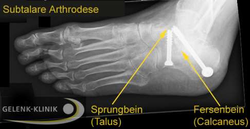Röntgenbild einer Arthrodese des Subtalargelenks. Das Gelenk zwischen Fersenbein und Sprungbein wird durch Schrauben endgültig versteift. Durch die stabile Unterstützung des in der richtigen Position fixierten Fersenbeines kann die normale Lage des Sprungbeines wiederhergestellt werden. © Gelenk-Klinik Röntgenbild der subtalaren Arthrodese
