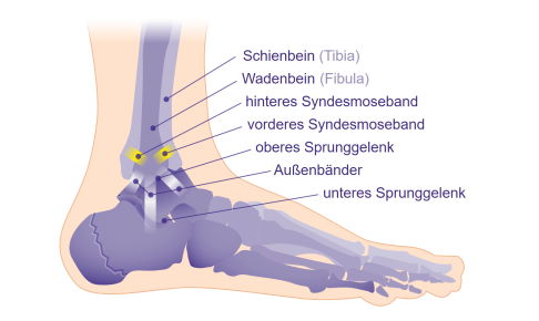 Die Syndesmosebänder stabilisieren die Position von Schienbein (Tibia) und Wadenbein (Fibula). Bei einem Syndesmosebandriss wird das Sprunggelenk instabil und überbeweglich. © Gelenk-Klinik Schema Syndesmosebänder