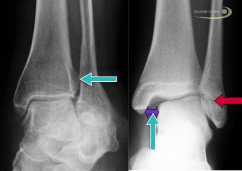 Röntgenbild von geschädigter Sprunggelenksgabel