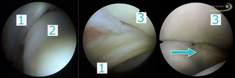 Arthroskopische Untersuchung eines Patienten mit Syndesmoseriss. 1: vordere Syndesmose, 2: Sprungbein, 3: Tibia und in der Mitte hintere Syndesmose. Im rechten Bild ist in der hinteren Syndesmose Narbengewebe sichtbar, das sich nach einer Ruptur mit insuffizienter Heilung bildete. Der Patient klagt weiterhin über ein instabiles Sprunggelenk. © Gelenk-Klinik Arthroskopie bei Syndesmosebandriss
