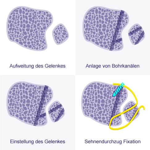 Schematische Darstellung der Bandplastik: Aufweitung oder Diastase der Sprunggelenksgabel führen sicher zu Arthrose des Sprunggelenks. Die Bandplastik mit Sehnengewebe kann - wenn noch keine Arthrose aber eine deutliche Instabilität vorhanden ist - häufig erfolgreich das Gelenk erhalten. Nach Anlage von Bohrkanälen und Einstellung (Reposition) des Gelenks wird ein Sehnenanteil als Ersatzgewebe eingezogen und fixiert. Diese Bandplastik ermöglicht eine Stabilität mit hoher Effektivität. Wichtig ist die richtige Einstellung der Sprunggelenksgabel. © Gelenk-Klinik Bandplastik