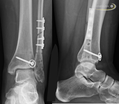 Bandplastik bei komplexer Fraktur mit Syndesmoseschaden